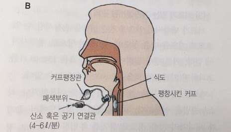 poryex|기관절개술, 기관절개관(Tracheostomy tube, portex, Tracoe) .
